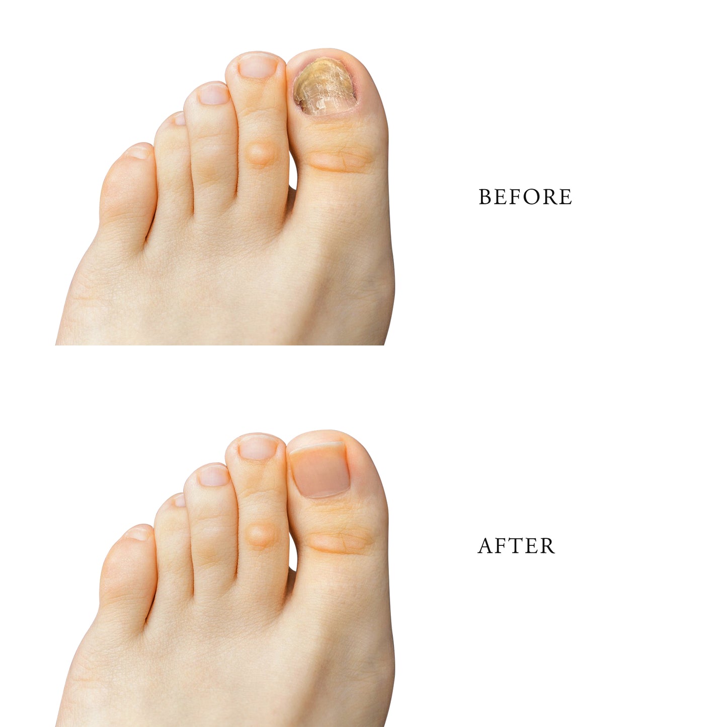 Anti Fungal Nail Treatment( 10 ml )