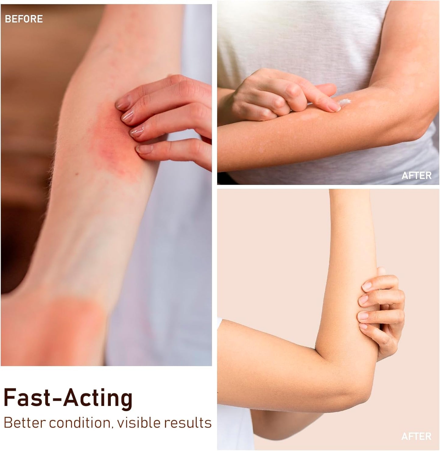 Yanail Antifungal Cream Jock Itch Cream Antifungal, Athletes Foot & Toenail Fungus Treatment，30ml