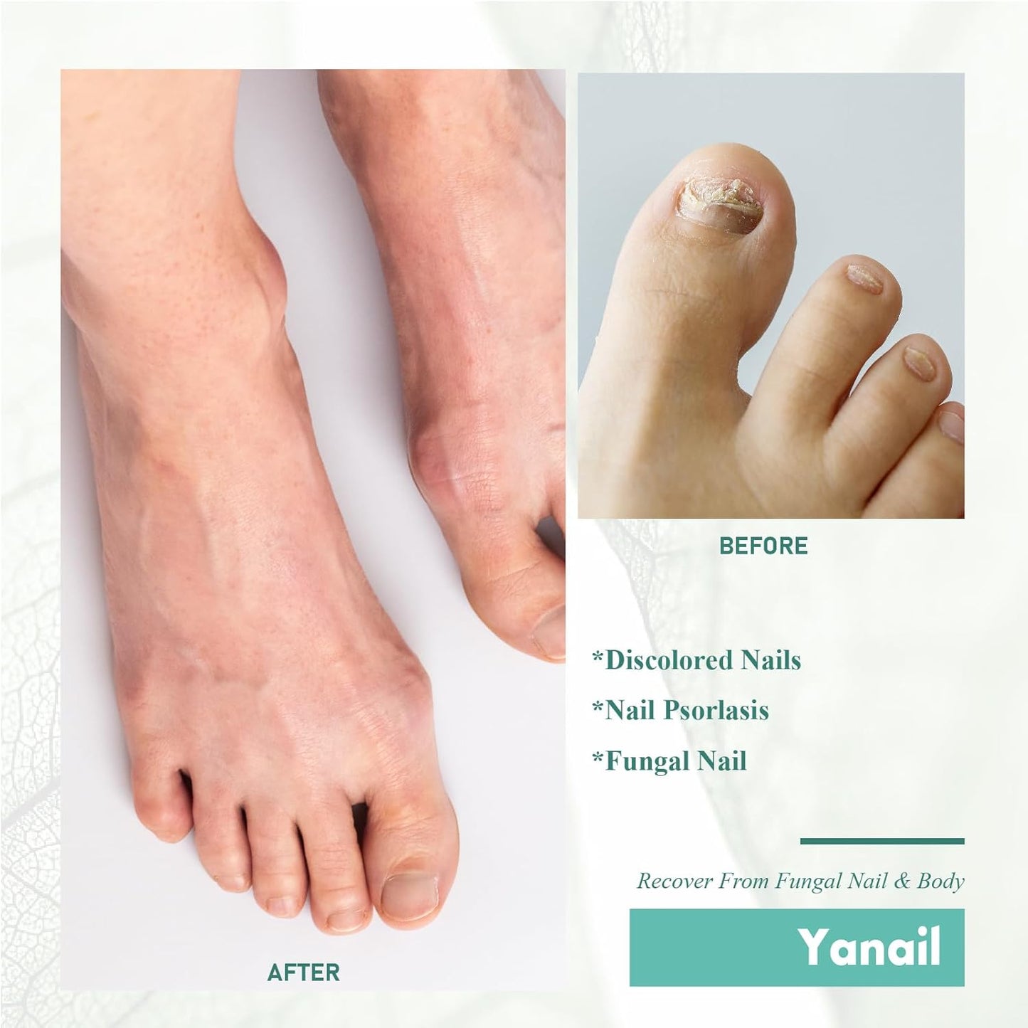 Yanail Fungal Nail Treatment & Antifungal Cream for Toenail