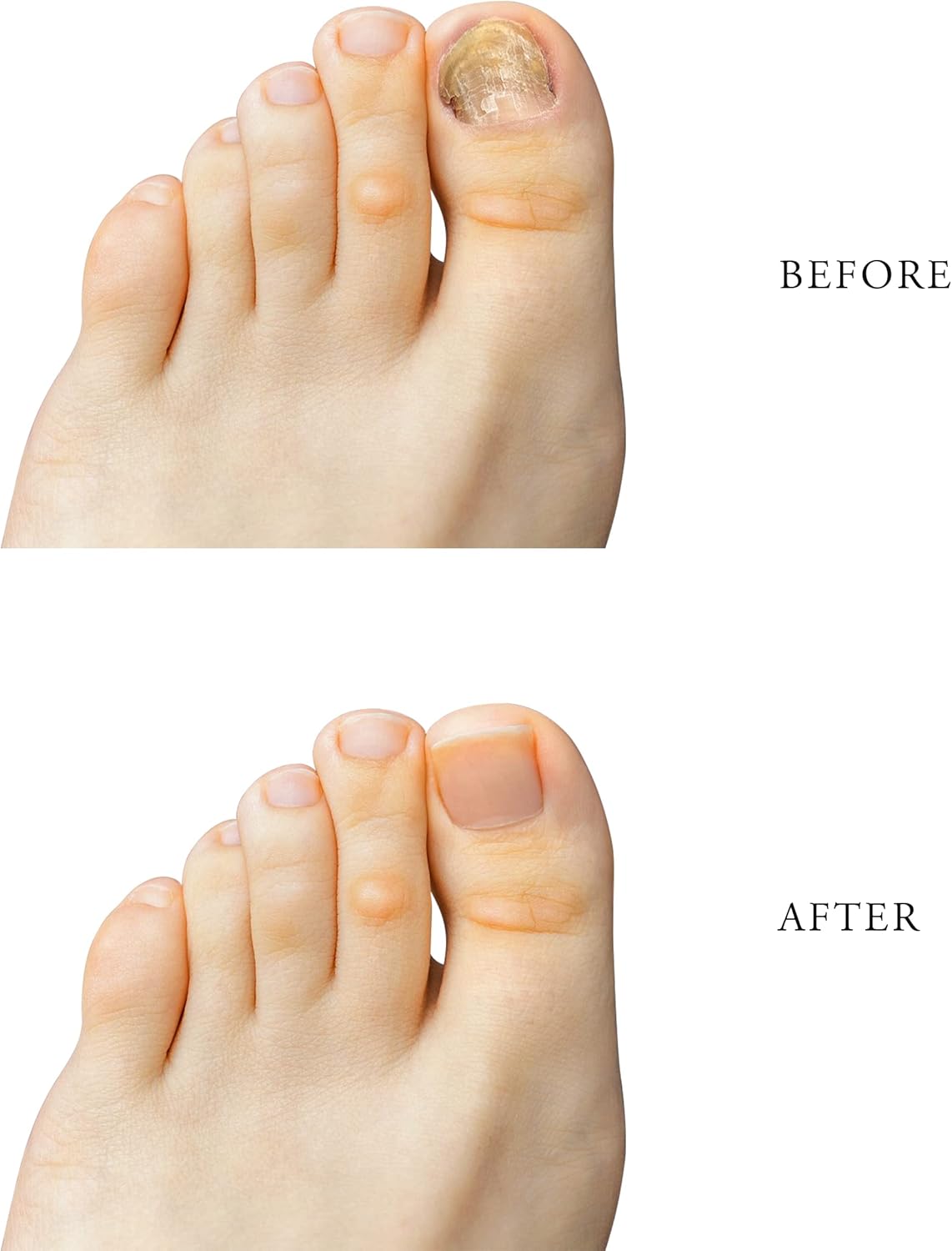 Yanail Fungal Nail Treatment For Toenails Extra Strong，5ml